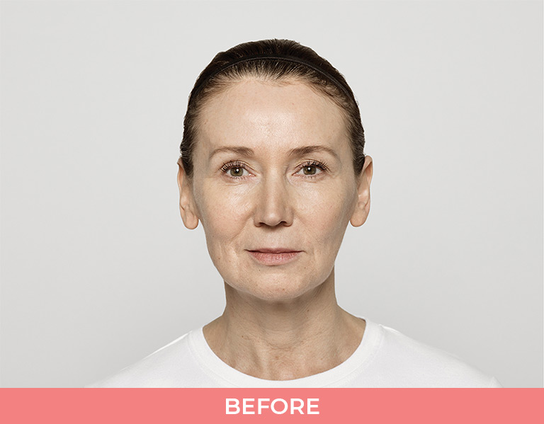 Restylane-Lyft-patient-Before Restylane-Lyft-patient-Before