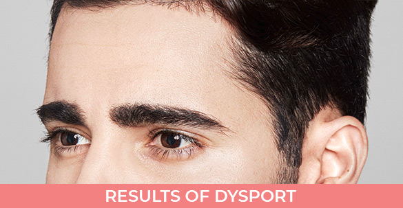 Results-of-Dysport