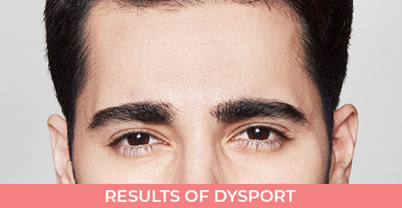 Results-of-Dysport