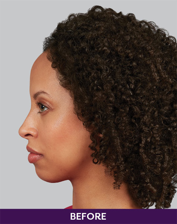 Results-of-Juvéderm-Voluma-Before Results-of-Juvéderm-Voluma-Before