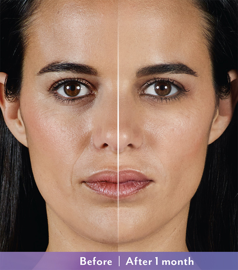 Results-of-Juvéderm®-Vollure-Before-After