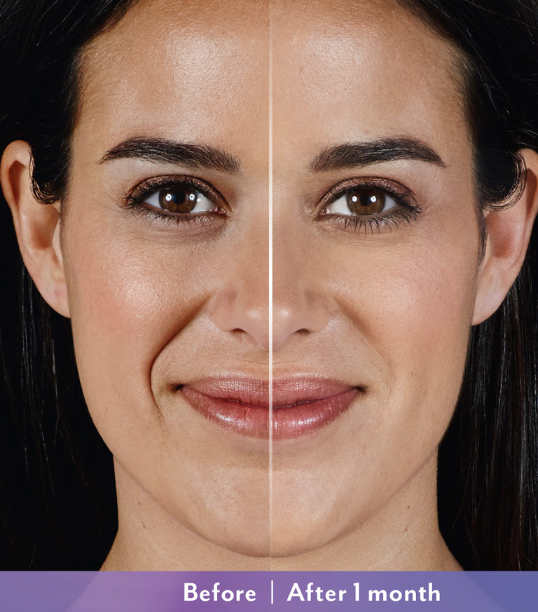 Results-of-Juvéderm®-Vollure-Before-After