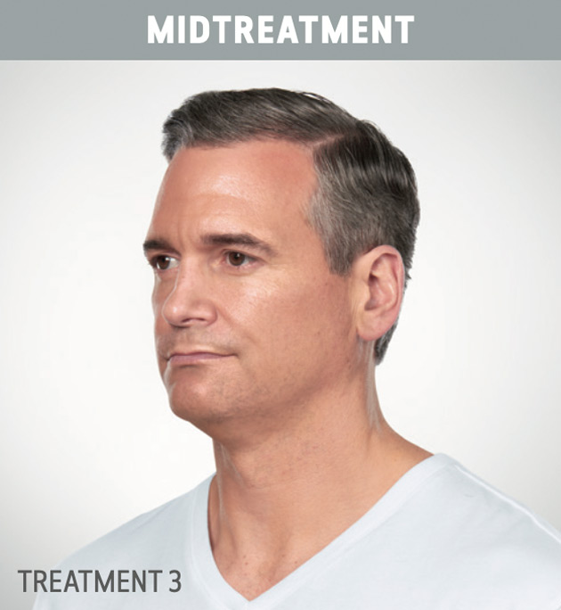 Results-of-Kybella-in-man Results-of-Kybella-in-man