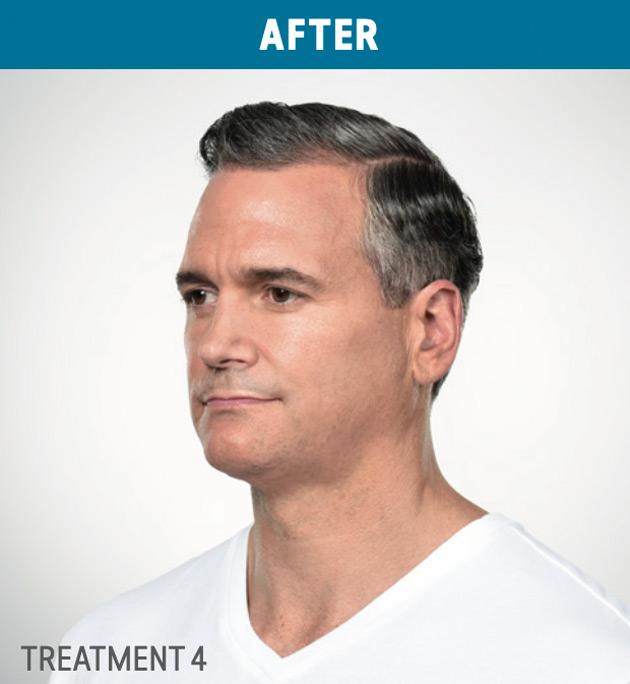 Results-of-Kybella-in-man