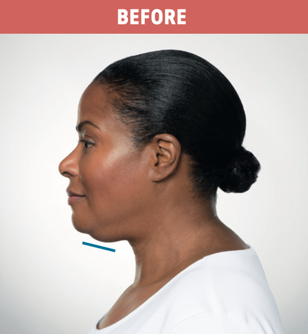 Results-of-Kybella-in-woman