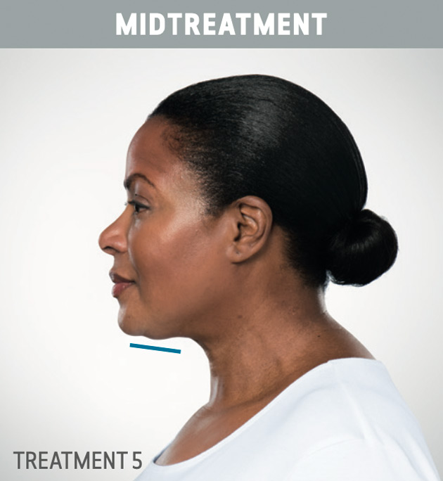 Results-of-Kybella-in-woman Results-of-Kybella-in-woman