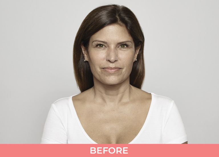 Results-of-Restylane-Treatment-Before