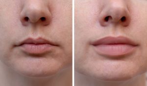 Natural-results-after-filler-for-the-lips