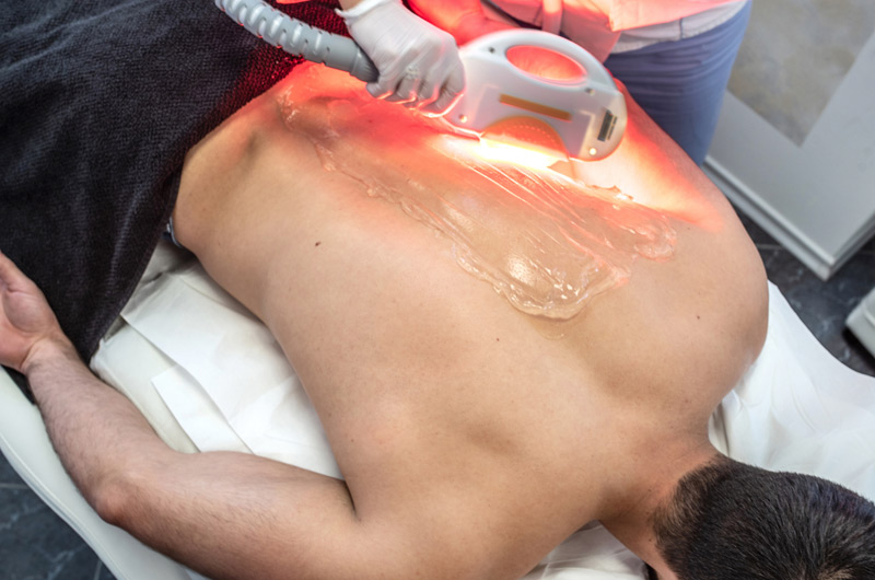 Man-receiving-laser-hair-removal-on-his-back