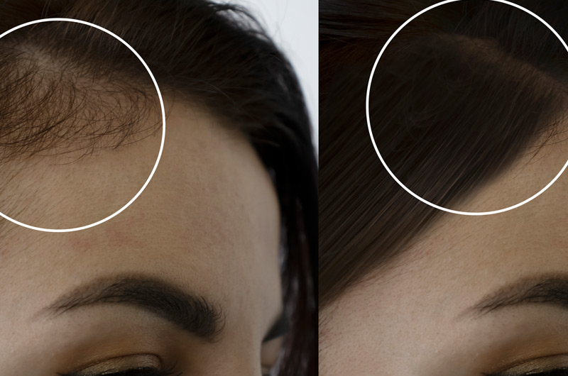 Before-and-after-photos-from-hair-loss-treatment