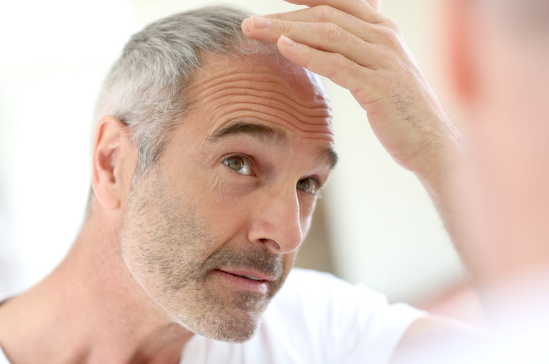 Man-experiencing-hair-loss-and-needing-PRP-Hair-Restoration