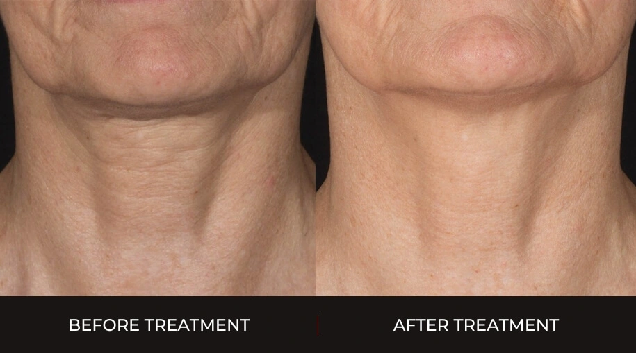 Potenza Skin Treatment Before and After